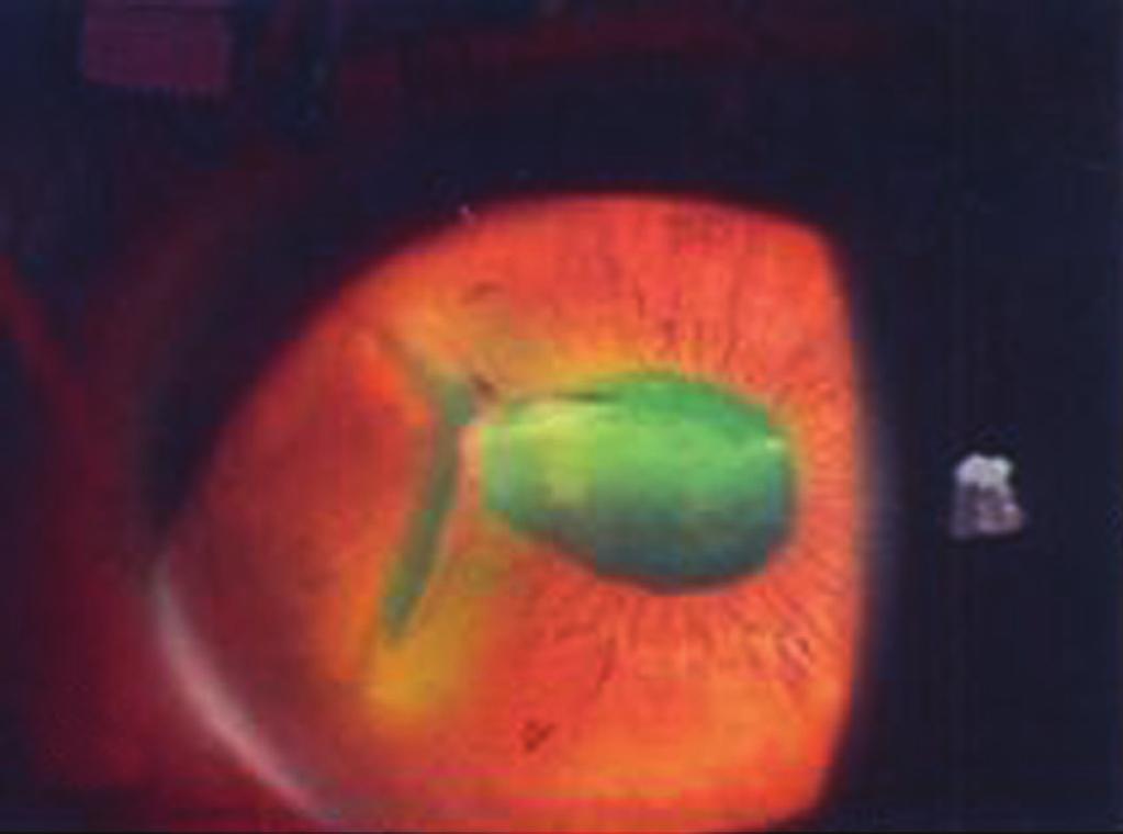(B) Anterior segment photograph showing central corneal opacity 2 months after the primary closure.
