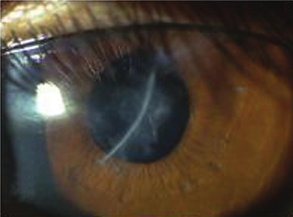 primary closure. (D) Centralization of RGP lens at fitting.