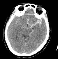 술후뇌 CTA에서중대뇌동맥원위부까지혈류가잘유지되고있었으나, 심한뇌부종및좌측전측두엽의경색소견을보이고있었다 (Fig. 2E, F). 비록뇌압조절을위해적극적인치료를하였으나환자는지속적식물상태가되었다.