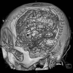 비죽상경화성동맥류는내탄력층의조직학적양상에의해고전적인박리성동맥류 (classic dissecing aneurysm), 분절확장 (segmental ectasia), dolichodectatic 박리성동맥류 (dissecting aneurysms), 그리고낭형동맥류