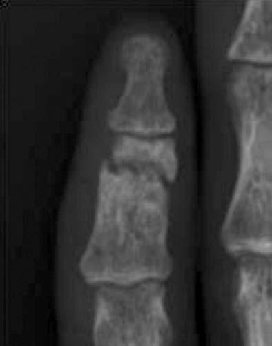 A 28-year-old man sustained middle phalanx fracture of