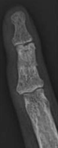the X-ray shows the medullary bridge of the fracture