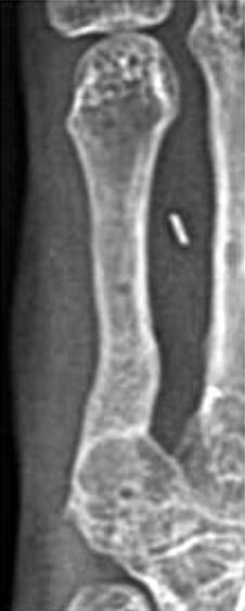 A 39-year-old woman sustained multiple open fracture