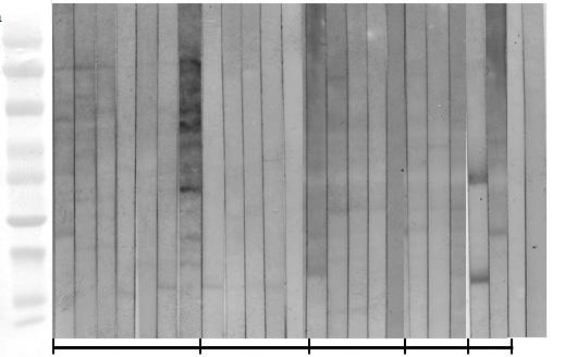 7 12 17 22.7 18.2 13 9.1 38 4.5 5 1 15 No. of patients (%) Fig. 3. Sodium dodecyl sulphate-polyacrylamide gel electrophoresis findings of dandelion pollen extracts using 4% 2% gel.