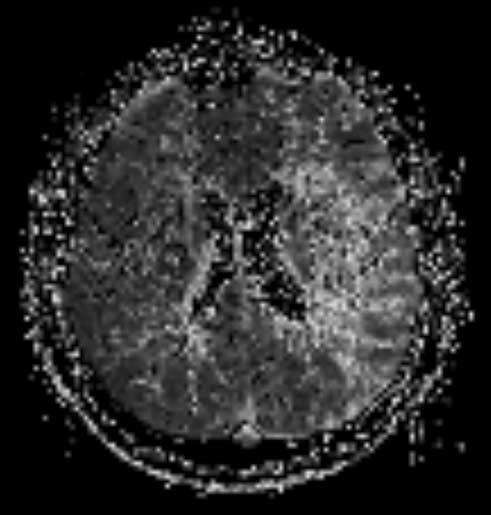 그러나방사선학적인소견, 즉 MRI나 CT 상에나타나는병변의크기와위치, 형태만으로는이러한대형동맥의이상에의한 열공유사경색 과소동맥의병변에의한순수열공경색을구분할수없으며다만뇌실주위변성이나잠행성피질하경색이열공경색에서더많이관찰된다는보고가있다 (12). 저자들의연구에서도 20 mm 이하의피질하소경색은다양한원인을보였다 (Table 1). 이중소혈관질환이 69.