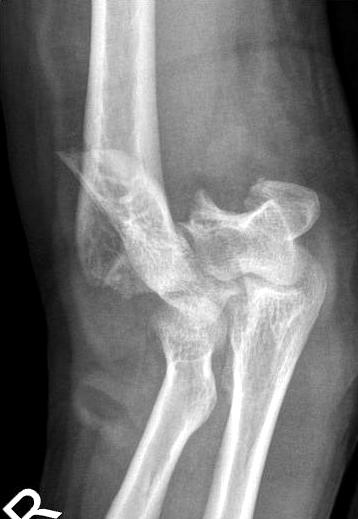 and it was possible to reduce the joint without osteotomy of olecranon, because it was separated between