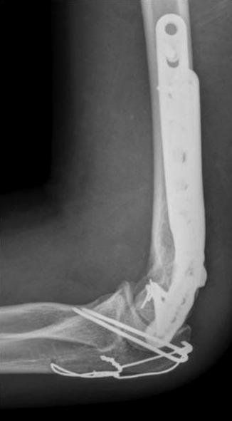 상완골원위부골절의치료 231 Fig. 16. A case to fix C2 fracture accompanied by a low lateral column fracture (arrow) successfully with parallel plating. 볼수있다.