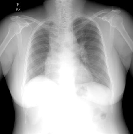 DY Kim, et al.: A case of isolated right pulmonary artery agenesis 은 27.7mmHg 로정상소견을보였다. 치료및경과 : 환자는입원이후고립성우측폐동맥형성부전증으로진단되어보존적치료후증상호전을보여, 외래에서추적관찰하기로하고퇴원하였다. 고찰 Figure 1.