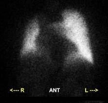 Tuberculosis and Respiratory Diseases Vol. 57. No. 5, Nov, 2004 Figure 3A. Ventilation scan : Ventilation scan showed normal finding.