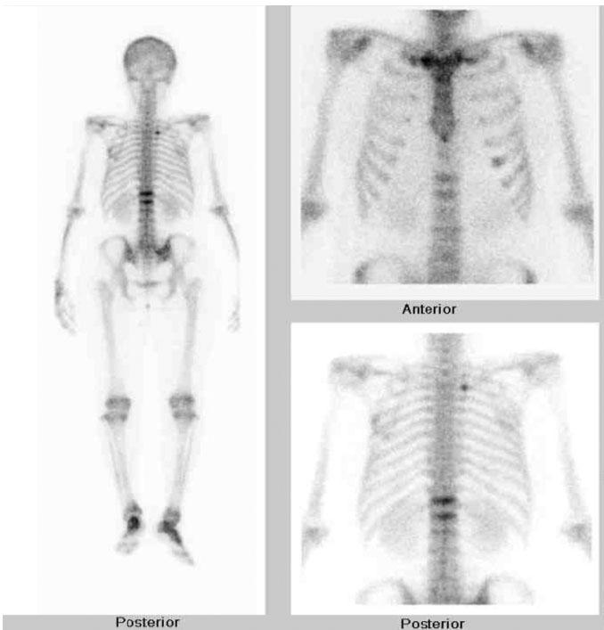 - 이상열외 10 인 : 척추압박골절의원인으로서감별진단된 I 형골형성부전증 1 예 - Fig. 5. No special abnormal findings were observed other than compression fractures of T12 and L1 bodies in 99m Tc bone scan images Table 1.