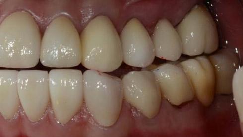 (A) Maxillary occlusal view, (B) Lateral