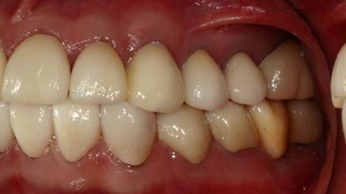 caps in oral cavity, (C) Pick-up