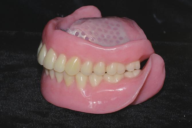 omparison of cross sectional view of new denture (solid line) and pre-existing denture