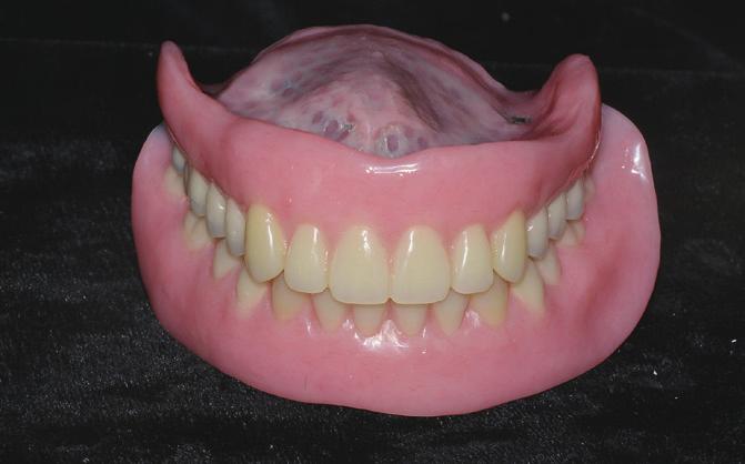() Frontal profile of first visit, () Frontal profile after definitive denture