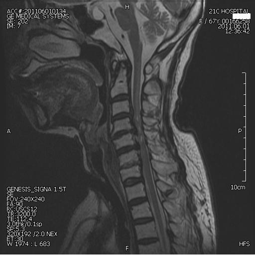 경추부척수손상사지마비환자의한방치료와기능적전기자극요법을통한상지재활치험 2 례 시상면에서 C4-5, C5-6, C6-7 level 의후종인대골화소견과동일 level의 spinal cord 내에 high signal의 cord edema가있어 spinal cord injury의소견을보였다 (Fig. 1).