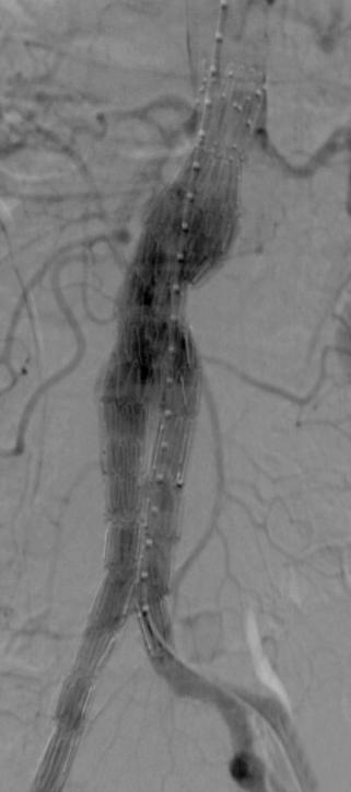 Daedo Park, et al: Delayed Type Ib Endoleak 143 Fig. 2. Computed tomography image shows rupture of the aneurysmal sac and retroperitoneal hematoma (arrow). Fig. 1. Angiographic images of previous endovascular aneurysm repair.