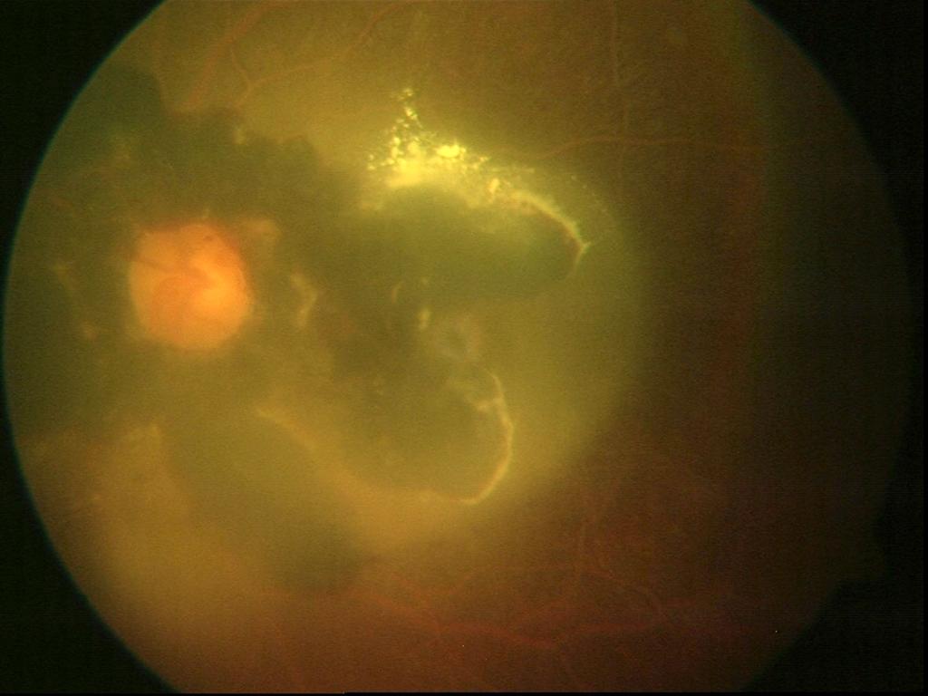 Optical coherence tomography (right) reveals normal retinal