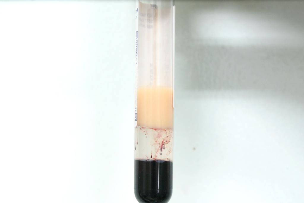 - 대한안과학회지 2014 년제 55 권제 4 호 - Figure 3. () blood specimen was lipemic with a triglyceride concentration of 2,676 mg/dl. () The blood specimen with a triglyceride concentration of 425.