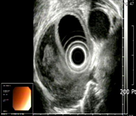 최진욱외박리성벽내성식도혈종 Fig. 1. (A) Preoperative Esophagogastroduodenoscopy and (B) Endoscopic Ultrasonography.