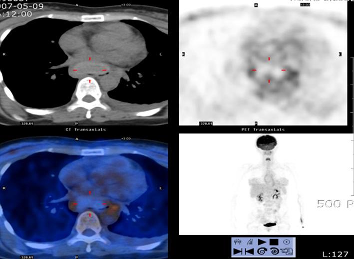 Chest CT scan (A) shows about 10 5 2 cm sized esophageal encircling soft tissue mass suggesting esophageal submucosal tumor such as leiomyoma.