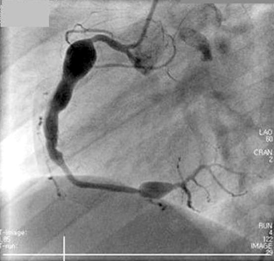 대한마취과학회지 : 제 54 권제 4 호 28 Fig. 1. (A) Left coronary angiogram. Aneurysm of the left main, interruption of the left anterior descending coronary artery (arrow). (B) Right coronary angiogram.