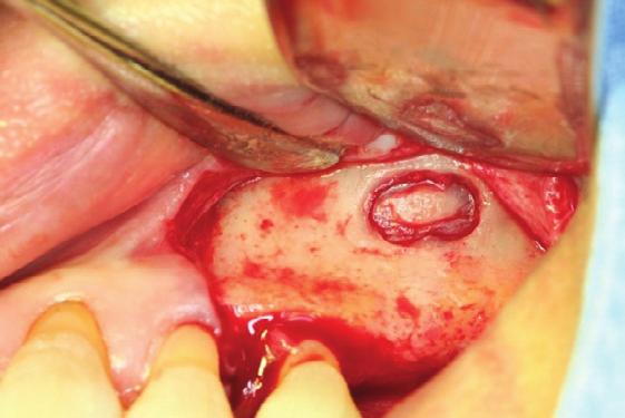 Piezo-surgery bur를 사용한 외측창 골 치에 잘 식립되었으며 골이식재도 거상된 상악동 막 아래 잘 절제술 집결되어 있었다(Fig. 17, 18).