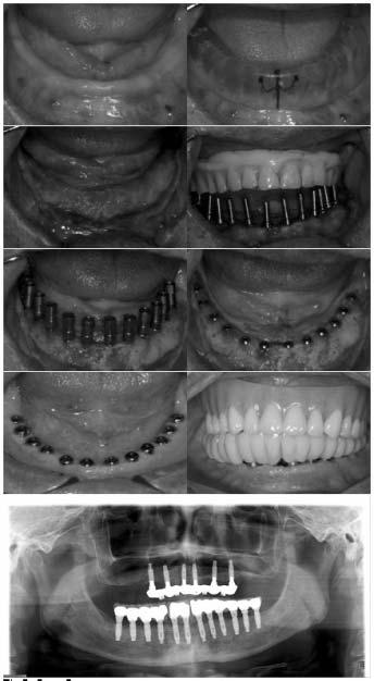 I: panoramic view of 68 months after surgery. Fig 6.