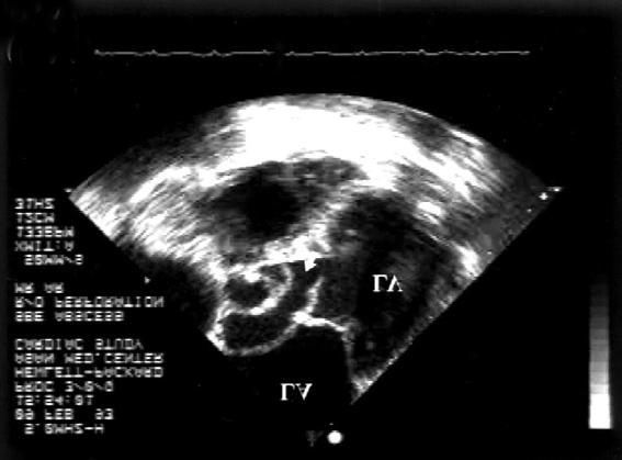of the AMVL. LA: left atrium, LV: left ventricle, Ao: aorta, AMVL: anterior mitral valve leaflet A B C Fig.