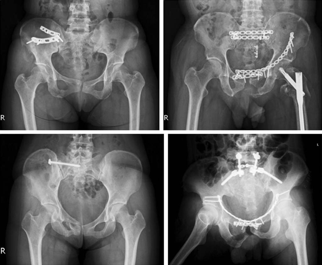 유의한연관성은찾기힘들었지만수직전단골절형에서상대적으로나쁜결과를보였다. 수술적고정방법에따른결과는골반내전방접근법을통한금속판고정술을시행한 9 예중 8 예가준 A B C Fig. 1. (A) Radiograph shows intra-pelvic anterior approach & plate fixation.