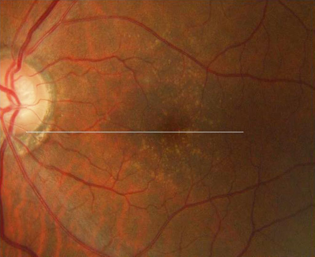 n example in the eyes with only drusen without exudative age-related macular degeneration.
