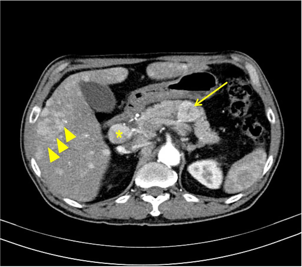 Jin Hee Noh, et al. Malignant melanoma of the pancreas and liver 중에서는 간, 뼈, 뇌로 비교적 빈번하게 전이가 되는 것으로 내원 당시 환자는 식욕부진과 전신 위약감을 호소하였고, 보고되고 있으며, 췌장으로 전이되는 경우는 매우 드물어, 생체 징후는 혈압 105/77 mmhg, 체온 36.