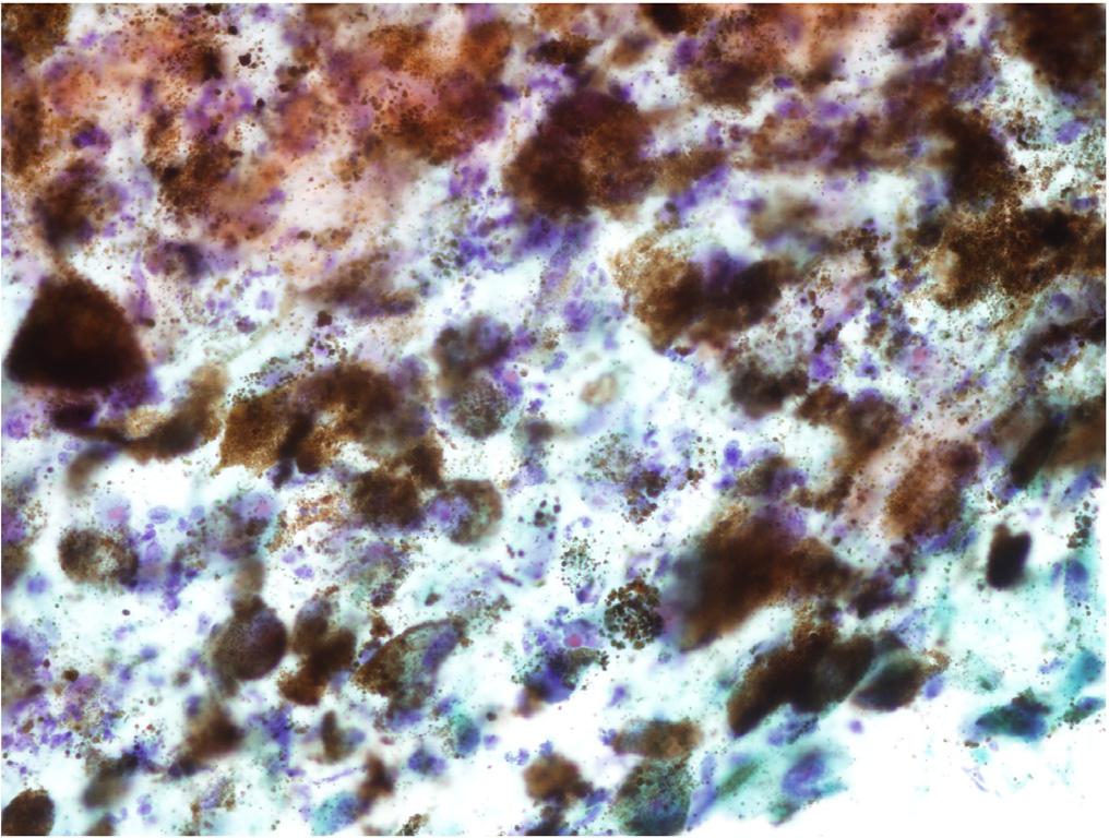 The tumor cells exhibited hyperchromatic pleomorphic nuclei and prominent nucleoli (all panels, Papanicolau staining, 40 ). 이타장기로전이되었을때원발부위가소실되는경우가 12.3% 로보고되고있다 [4].