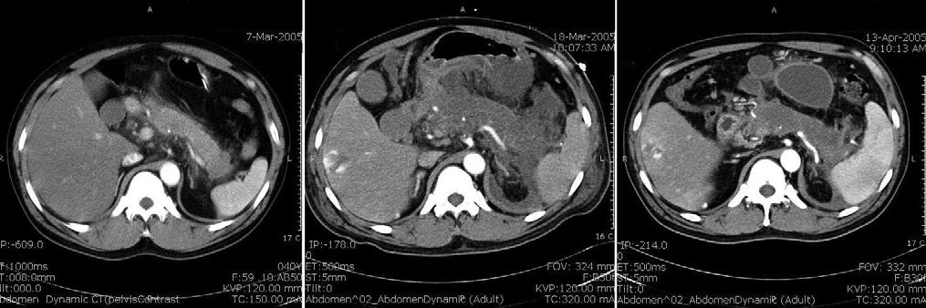 - Hye-Jin Seo, et al : Peritoneal dialysis in acute pancreatitis complicated by acute renal failure - A B C Figure 1. Peripancreatic inflammation and minimal fluid collection were seen.
