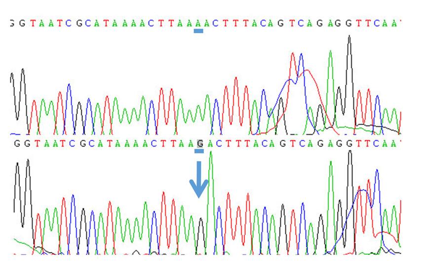 3268a > G of MT-TL1 Figure 4. M utation chromatogram of the patient. A mutation of MT-TL1; m.3268 A> G homoplasmy mutation. The 37th nucleotide A of MT-TL1 gene was substituted by G.