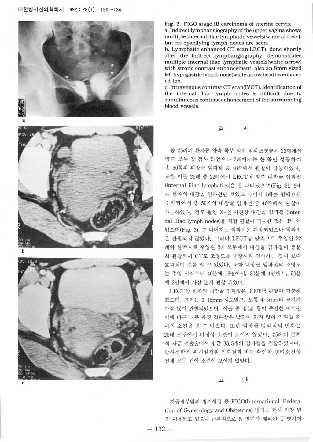 대한방사선의학회지 1992; 28(1) : 130~134 짧 a Fig. 2. FIGO stage IB carcinoma of uterine cervix. a. Indirect lymphangiography ofthe upper vagina shows multiple internal iliac lymphatic vessels(white arrows}.