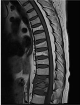 (B) MR analysis of the spine, showing multiple old compression fractures at T4, T5, T8, T9, L2, L3, and L4, and recent fractures with edema at T11 and T12. Table 1.