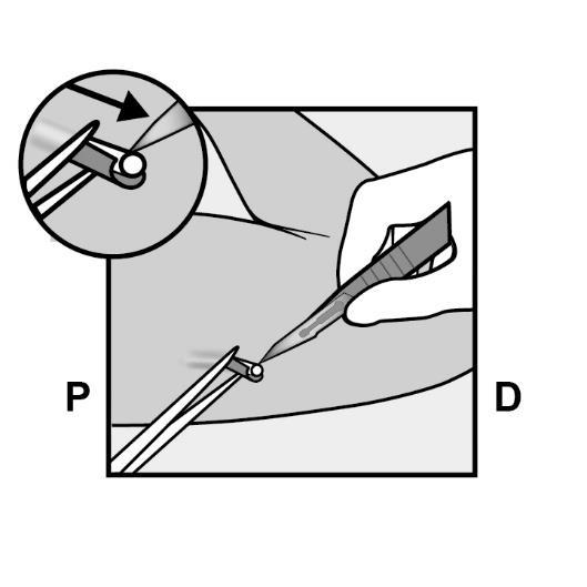 Figure 13 Figure 14 Figure 15 - 만약절개시이식제의끝부분이보이지않으면, 절개부위속으로포셉 ( 가급적곡선의작은지혈포셉권장, 끝은위로향함 ) 을살짝밀어넣는다 (Figure 16).