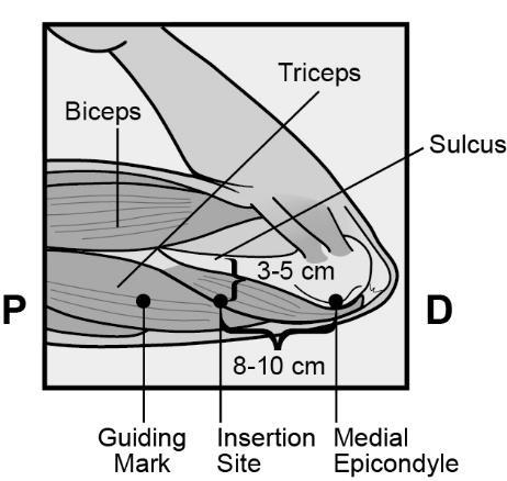 Figure 2b Figure 2c ( 팔꿈치쪽에서본왼쪽상완의단면 ) - 팔에표시를한후팔안쪽의정확한위치인지확인한다. - 삽입부위에서가이드표시까지의피부를소독제로닦는다.