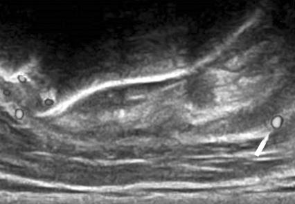 221 Comparison between Complete and Minimal Bursectomy in Early 3 Months A B C Figure 2. Power Doppler ultrasound image of the repaired rotator cuff at the peritendinous region.
