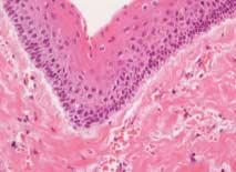 전신마취하에병소는단일조각으로적출되었으며적출된조직에대한조직병리학적검사를통해각화낭성치성종양으로진단되었다 (Fig. 6).