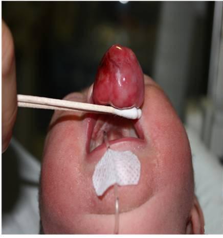 류지원외 4 인. 태아선천성치은종 Fig. 2. () Gross examination of congenital epulis after birth.
