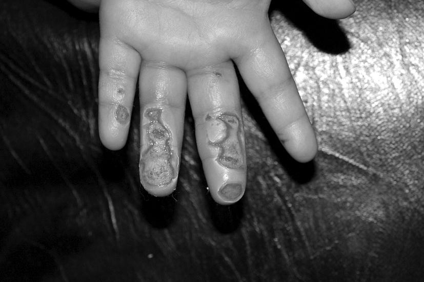 114 대한화상학회지 Vol. 14, No. 2, 2011 Fig. 3. A 16-month-old male patient with 2nd degree electrical burn on left 3, 4, 5 fingers. (A) 4 days after injury.
