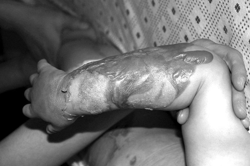 최우영 등 2도 화상 환자의 치료에서 동종 유래 배양피부(칼로덤)의 유용성 115 Fig. 4. A 25-month-old female patient with 2nd degree scalding burn on right forearm. (A) 2 days after injury. (B) 7 days after application of Kaloderm.