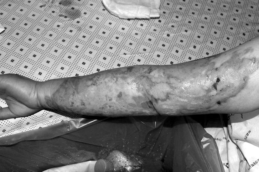 116 대한화상학회지 Vol. 14, No. 2, 2011 Fig. 5. A 52-year-old female patient with 2nd degree scalding burn on left arm. (A) 5 days after injury. (B) 5 days after application of Kaloderm.