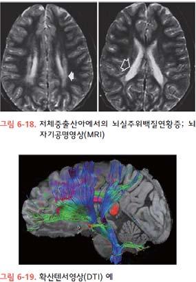 영상의학적검사 보행 뇌성마비임상적진단에도움을줄수있는검사법 컴퓨터단층촬영 (computed tomography; CT) 자기공명촬영 (magnetic resonance imaging, MRI) 확산텐서영상 (diffusion tensor image; DTI) 인간이가장많이사용하는이동방법으로움직임에문제를갖는소아에게가장중요한활동지표임뇌성마비 5세시점