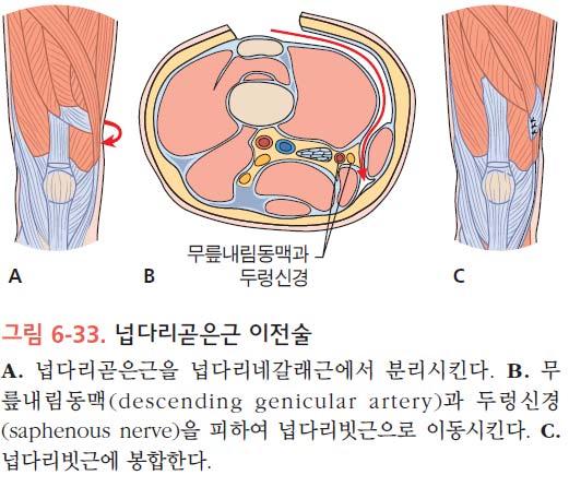 추가적으로엉덩관절구성형술도실시 무릎관절에대한수술 굽힘구축 넙다리뒤근연장술 뒤관절주머니유리술