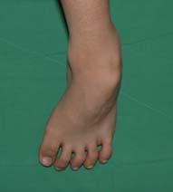 Foot and Ankle Equinovarus Hemiplegia >>> Diplegia or Quadriplegia Hind foot varus - Posterior tibialis Forefoot varus/supination -