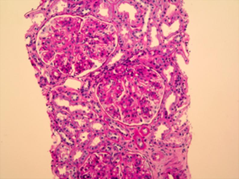 Capillary loops are focally thickened with subendothelial deposition (H&E stain, 400).