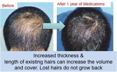 Transplanted hairs do not need any medications for maintenance.
