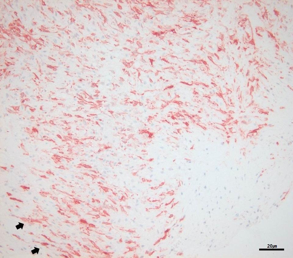 () Spindle cell proliferation with reticular fiber in prominent hypovascular